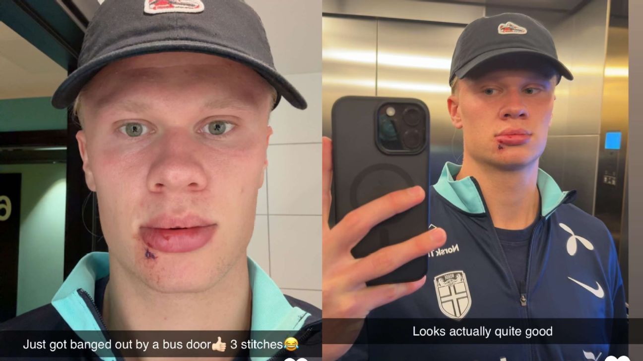 Haaland's Bus Mishap Leads To Facial Injury, Surgery Required